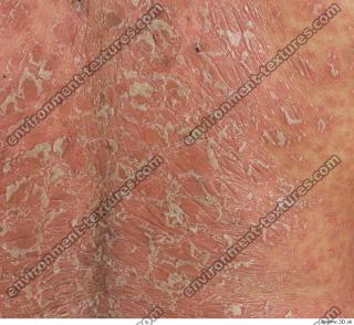 photo texture of scarred skin 0005